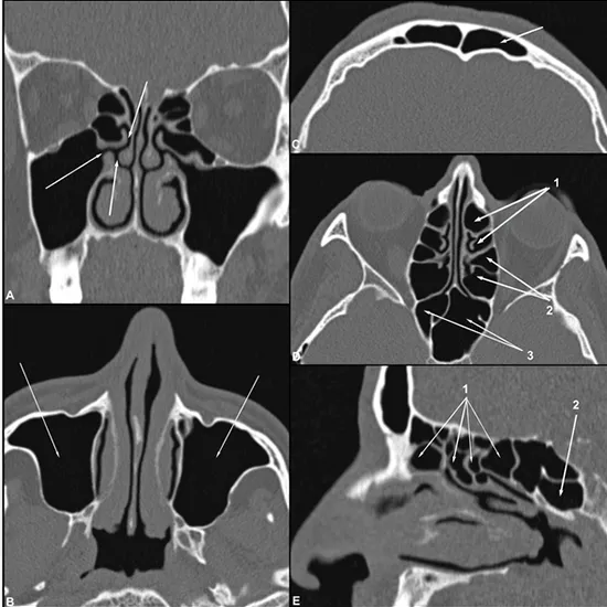Paranasal Sinus Computerised Tomography (PNS) Test